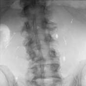 Sparse intraoperative X-ray view one