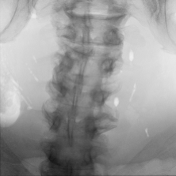 Sparse intraoperative X-ray view two