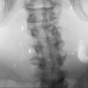 Sparse intraoperative X-ray view three